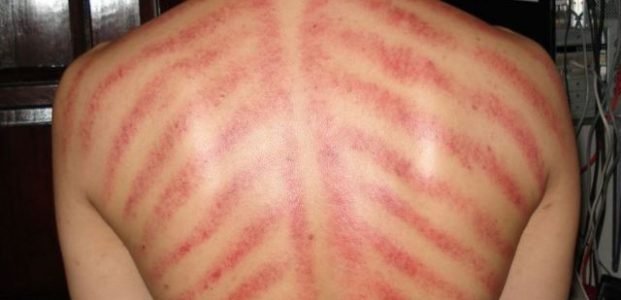 Anggapan Keliru Masuk Angin dan Bahaya Dikerok Anggapan Keliru Masuk Angin dan Bahaya Dikerok
